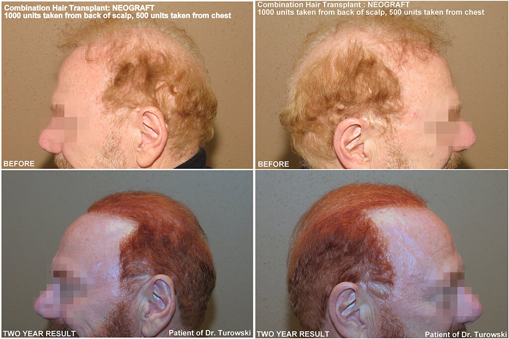 Body Hair Transplant – Before and After Pictures * | Dr Turowski - Plastic  Surgery Chicago