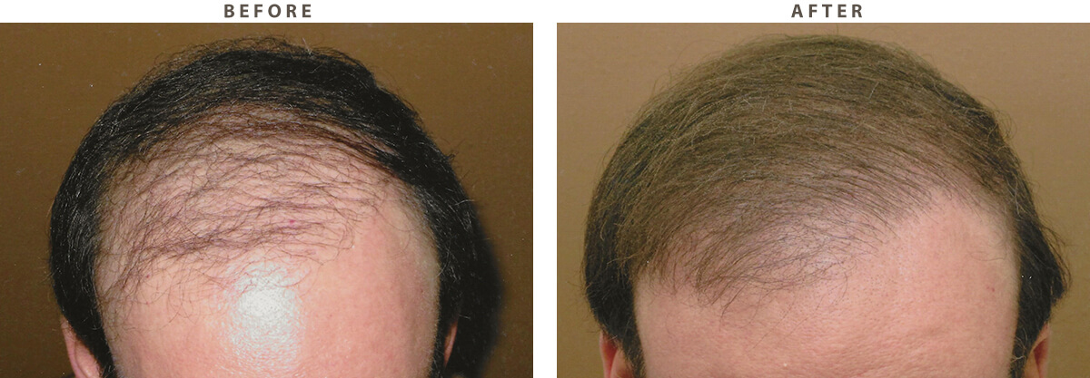 Body Hair Transplant – Before and After Pictures * | Dr Turowski - Plastic  Surgery Chicago