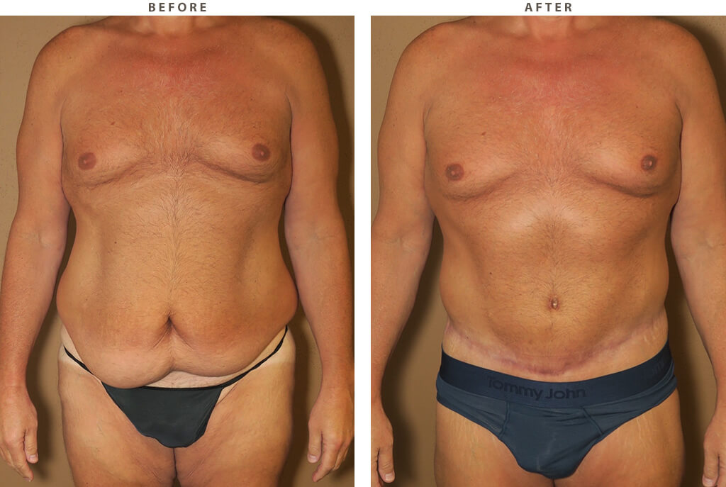 Belt Lipectomy Before and After 01