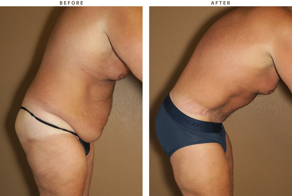 Male Tummy Tuck in Toronto (Belt Lipectomy)