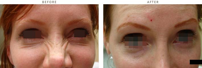 Botox - Before and After Picture