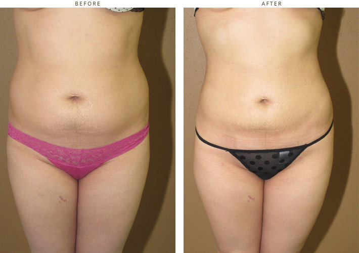 Brazilian buttock lift - before and after pictures