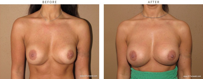 Revision Breast Surgery - Before and After Pictures
