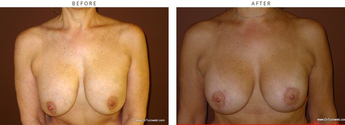 Breast Asymmetry – Before and After Pictures