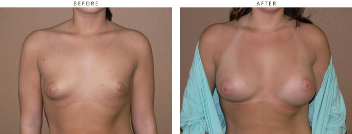 Tuberous breast correction Chicago - Before and After Pictures