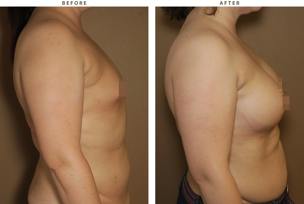 Liposuction – Before and After Pictures *