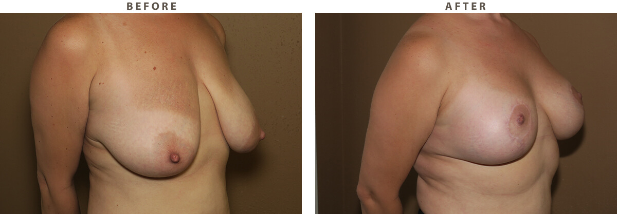 Breast lift Chicago - Before and After Pictures