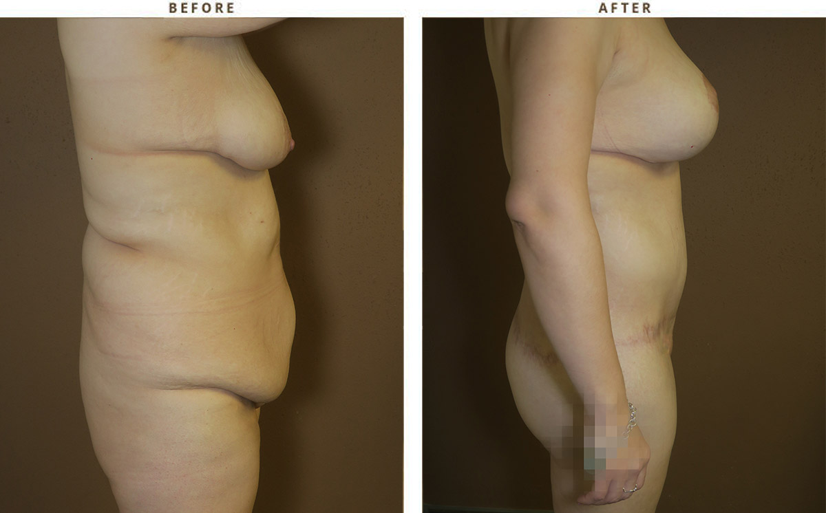 Belt Lipectomy – Before and After Pictures *