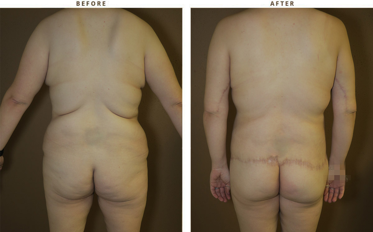 Belt Lipectomy Before & After, Case 2