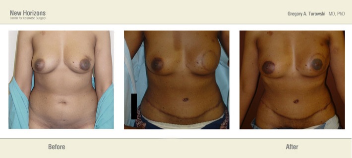 Breast Reconstruction - Before and After Pictures