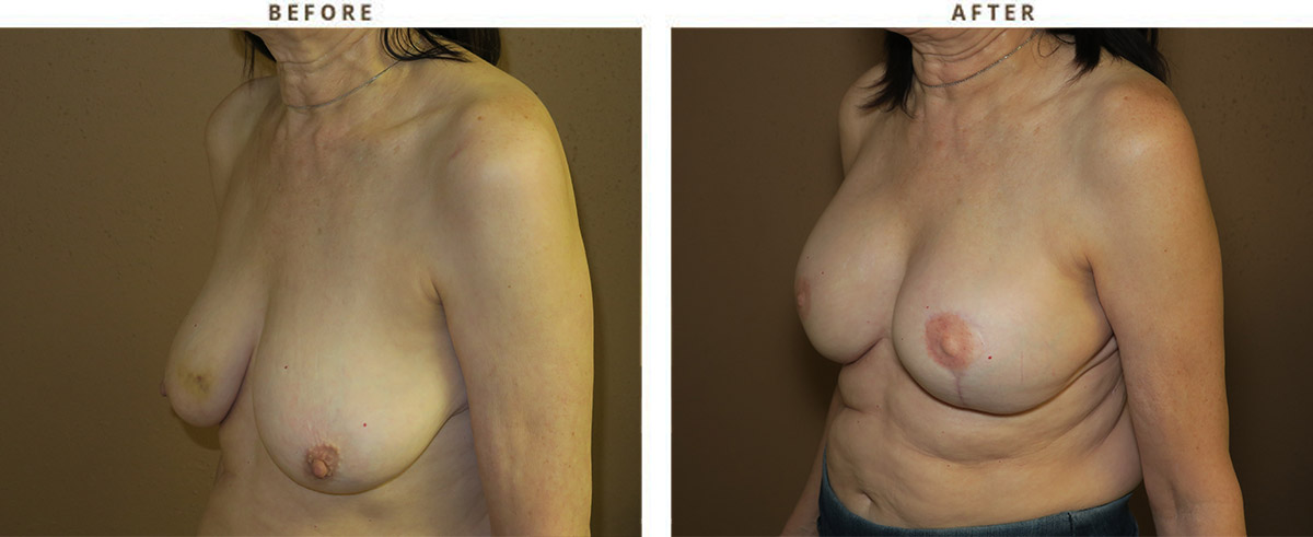 Vertical Mastopexy (breast lift) no implants