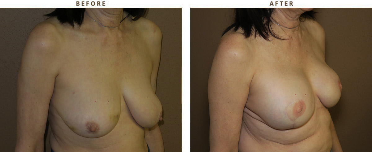 Vertical Mastopexy (breast lift) no implants