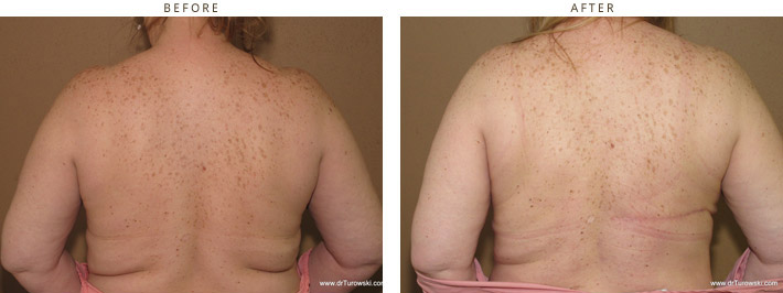 Breast Reconstruction - Before and After Pictures