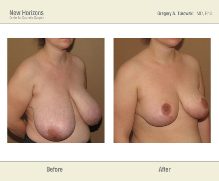Breast Reduction - Before and After Pictures