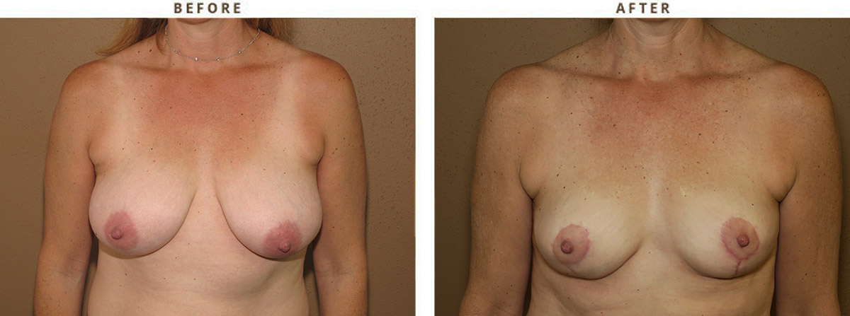 Breast reduction – Before and After Pictures