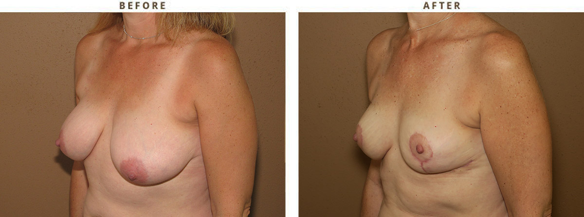 Breast reduction – Before and After Pictures