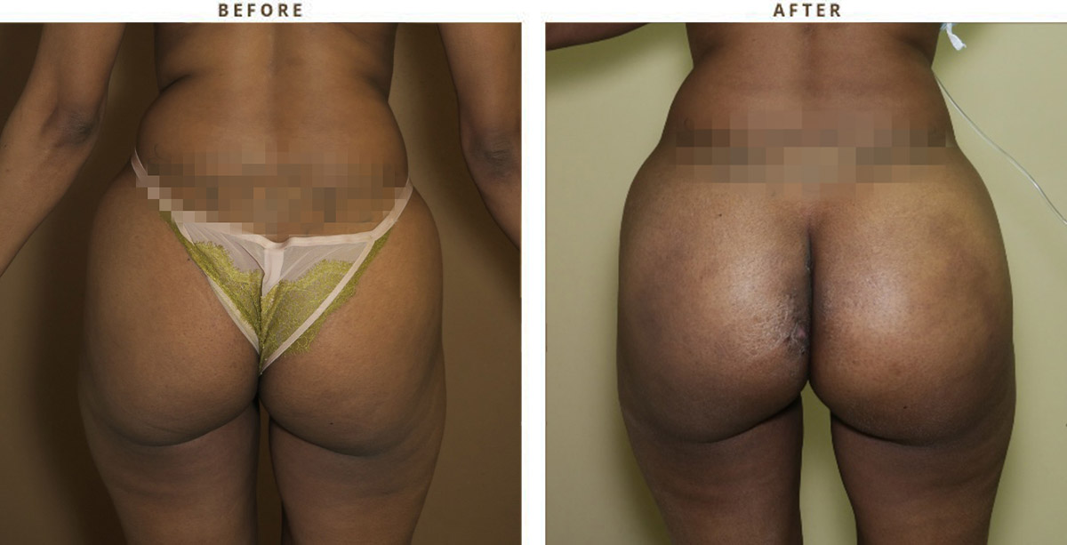 Buttock Lift vs. Butt Implants vs. BBL: What's the Difference? - Dr.  Vasilakis
