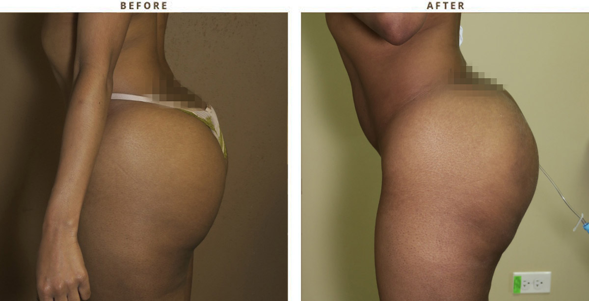 Dr. Francis Buttock Augmentation with Implants Before & After
