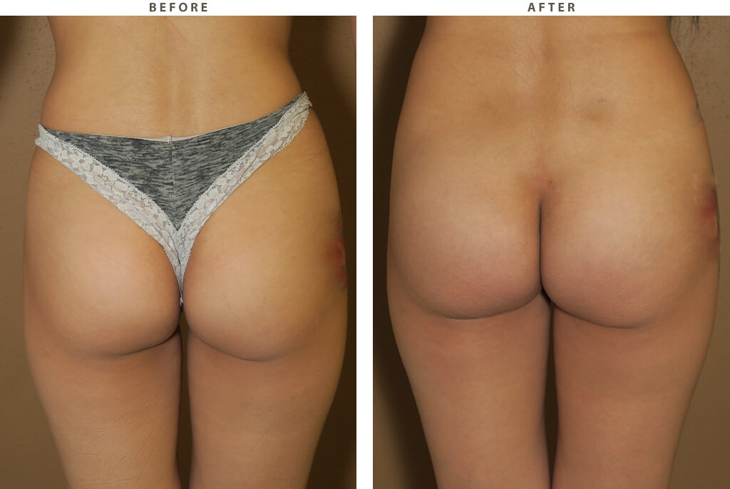 Butt Implants - Before and After Pictures