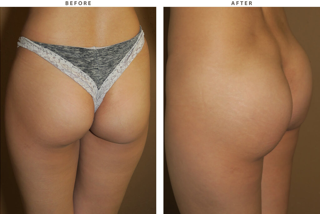 Butt Implants - Before and After Pictures