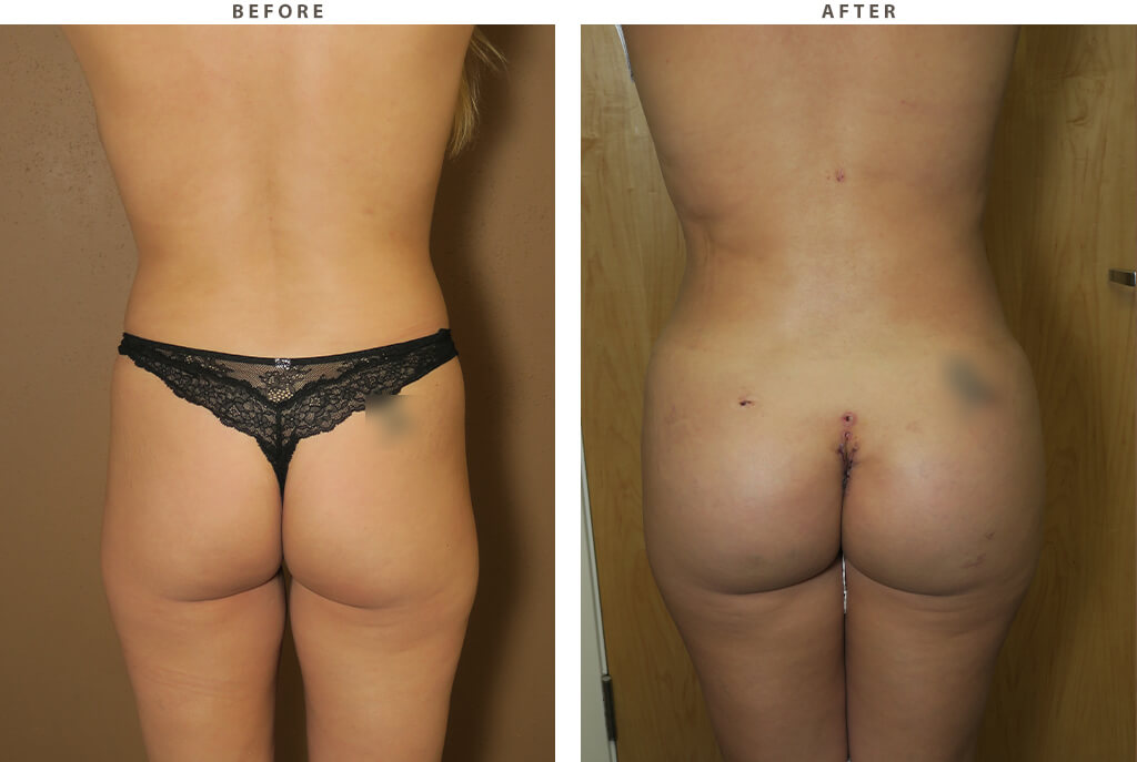 Buttock Augmentation - Before and After Pictures
