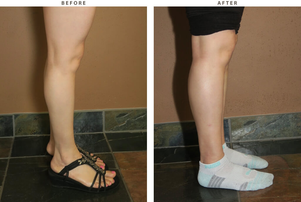 Calf Augmentation Before and After Pictures * Dr Turowski Plastic