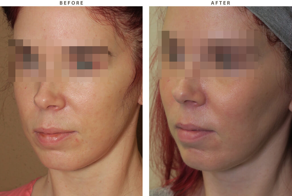 Cheek Implants - Before and After Pictures
