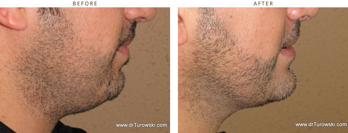 Chin Augmentation - Before and After Pictures