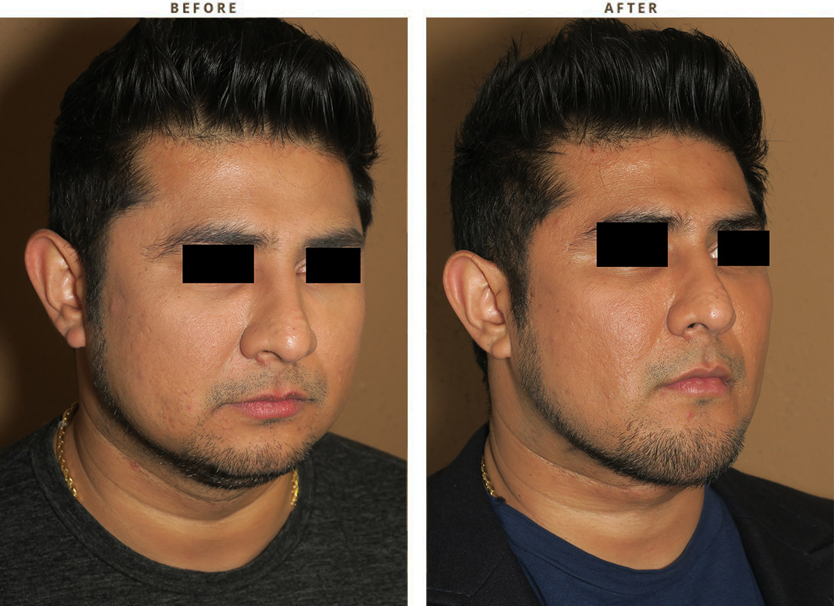 buccal fat pad removal male