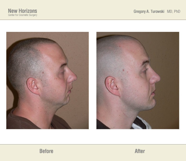 Chin Augmentation - Before and After Pictures