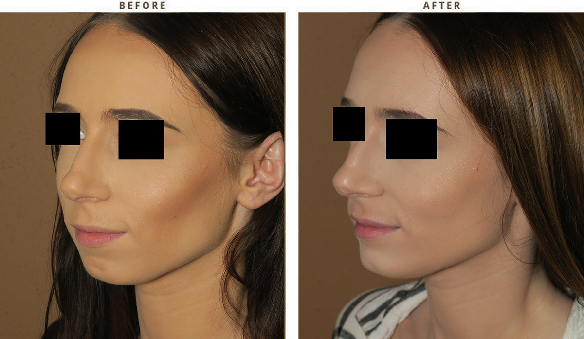 Chin augmentation and rhinoplasty – Before and After Pictures