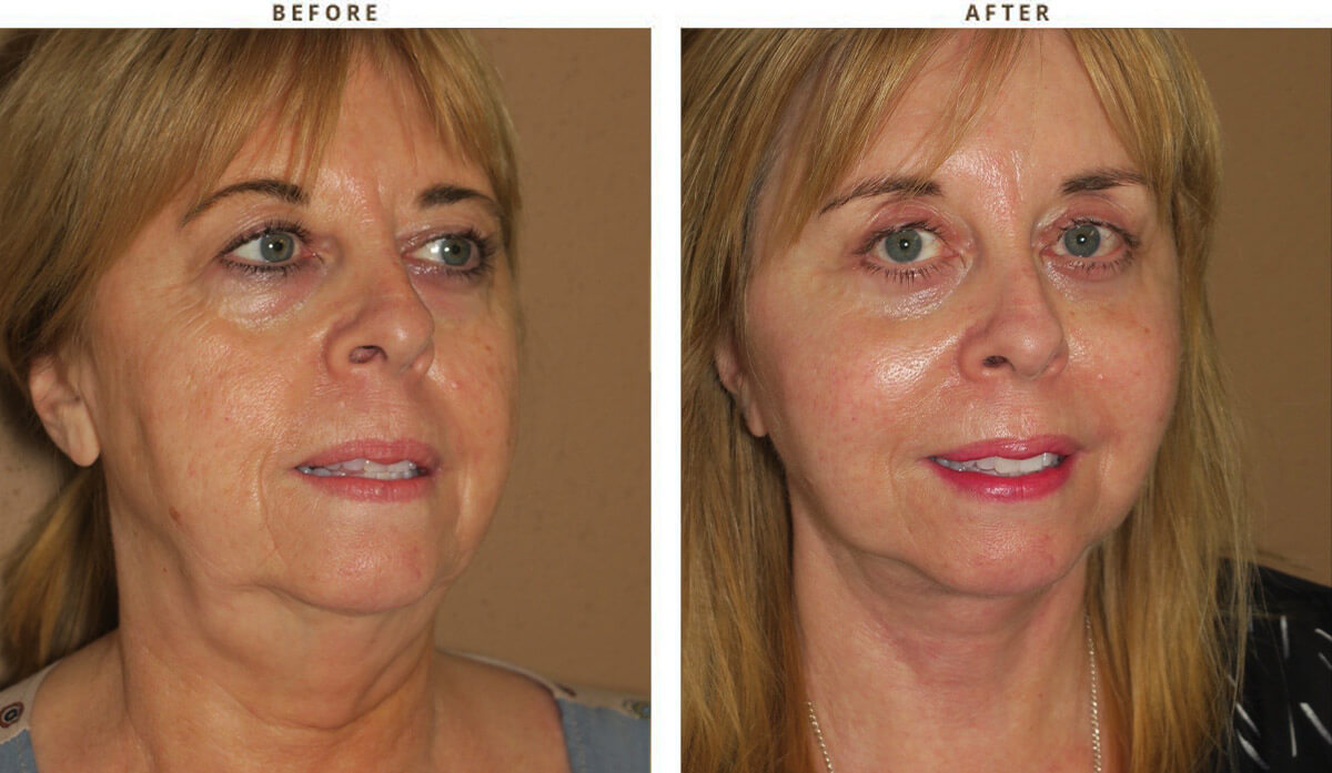 Complex Facial Rejuvenation - Before and After Pictures