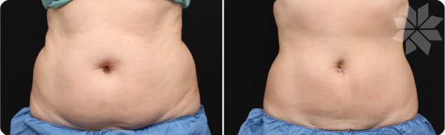 Coolipo - Before and After Pictures