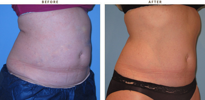 Coolsculpting – Before and After Pictures * – Dr Turowski ...