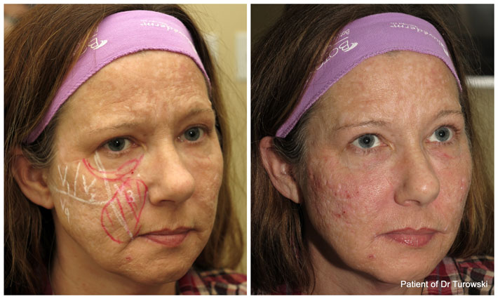 Immediate results of cheek augmentation and lift with Voluma - newly FDA approved filler - works great and for 2 years!