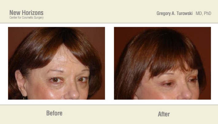 Eyelid lift surgery – Before and After Pictures