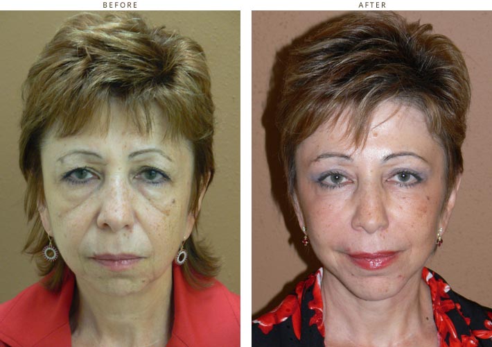 Face Lift - Before and After Pictures