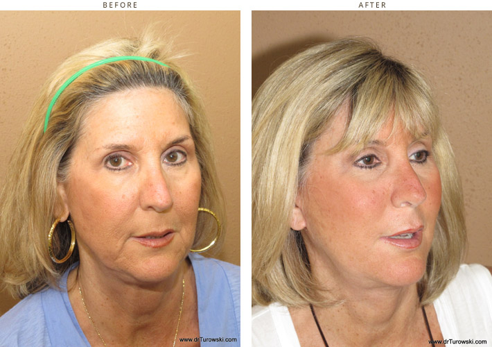Complex Facial Rejuvenation - Before and After Pictures