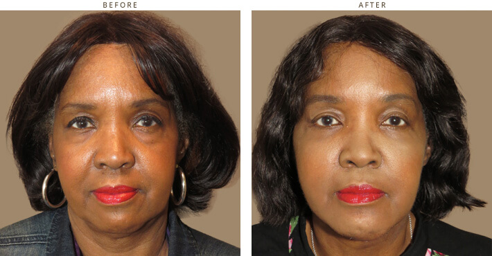 Eyelid lift surgery - Before and After Pictures.