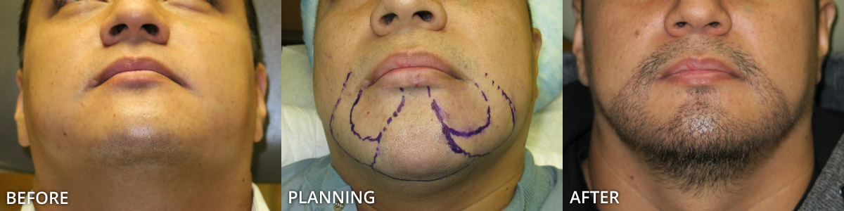 Facial Hair Transplant - Before and After Pictures