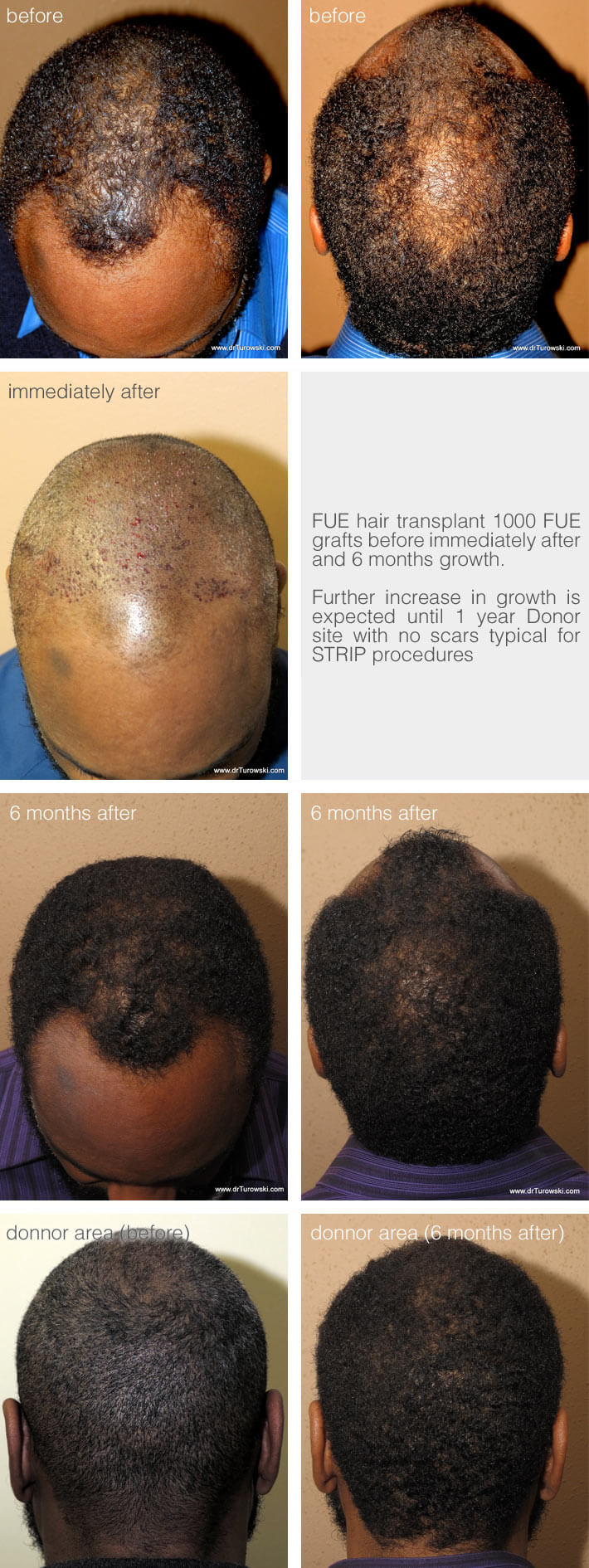 FUE hair transplant - 1000 grafts