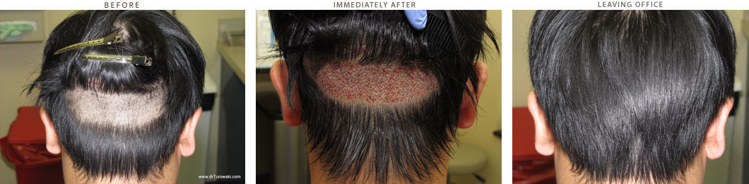 donor site at the back of the head does not have to be always totally shaved. In more limited cases (up to 1200 FUE) we can use regional shave (just like in female hair transplant) and leave patient with almost undetectable donor site leaving the office after procedure. This allows patients to return to life as usual as soon as couple days after the procedure