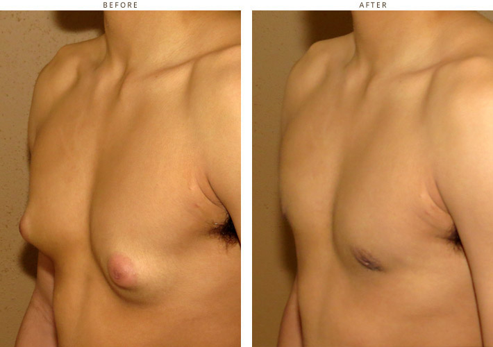 Gynecomastia Correction - Before and After Pictures