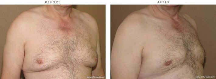Gynecomastia Correction - Before and After Pictures