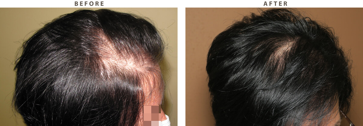 Female Hair Transplant – Before and After Pictures * | Dr Turowski -  Plastic Surgery Chicago