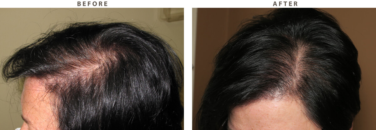 Female Hair Transplant – Before and After Pictures * | Dr Turowski -  Plastic Surgery Chicago