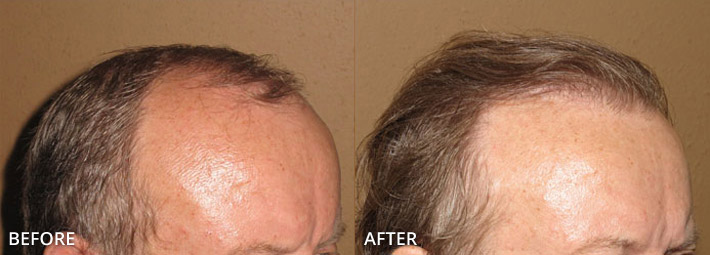 FUE Hair Transplantation – Before and After Pictures
