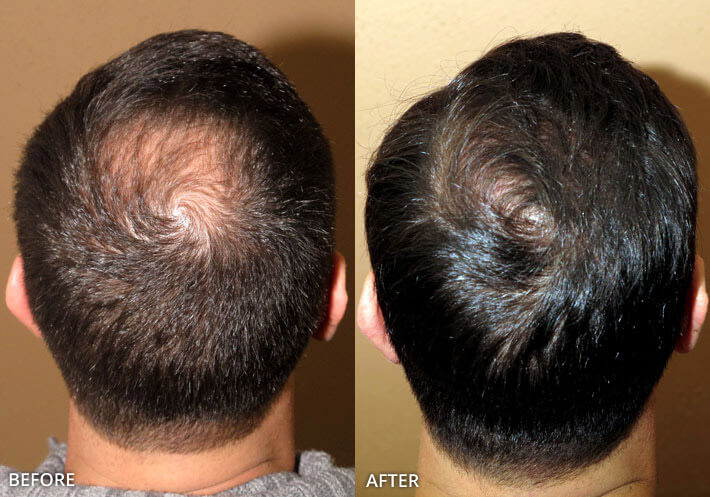 FUE Hair Transplantation – Before and After Pictures | Dr Turowski -  Plastic Surgery Chicago