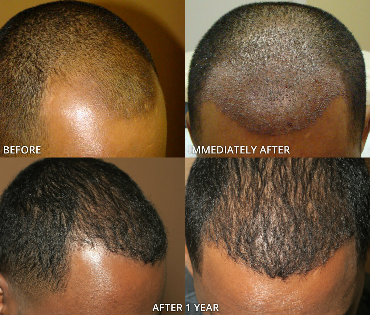 Fue Hair Transplantation Before And After Pictures Dr Turowski Plastic Surgery Chicago