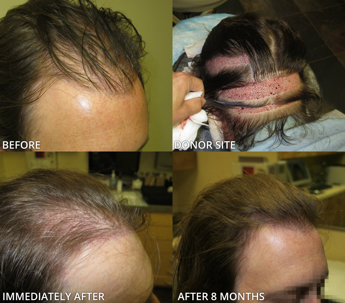 FUE Hair Transplantation – Before and After Pictures * | Dr Turowski -  Plastic Surgery Chicago